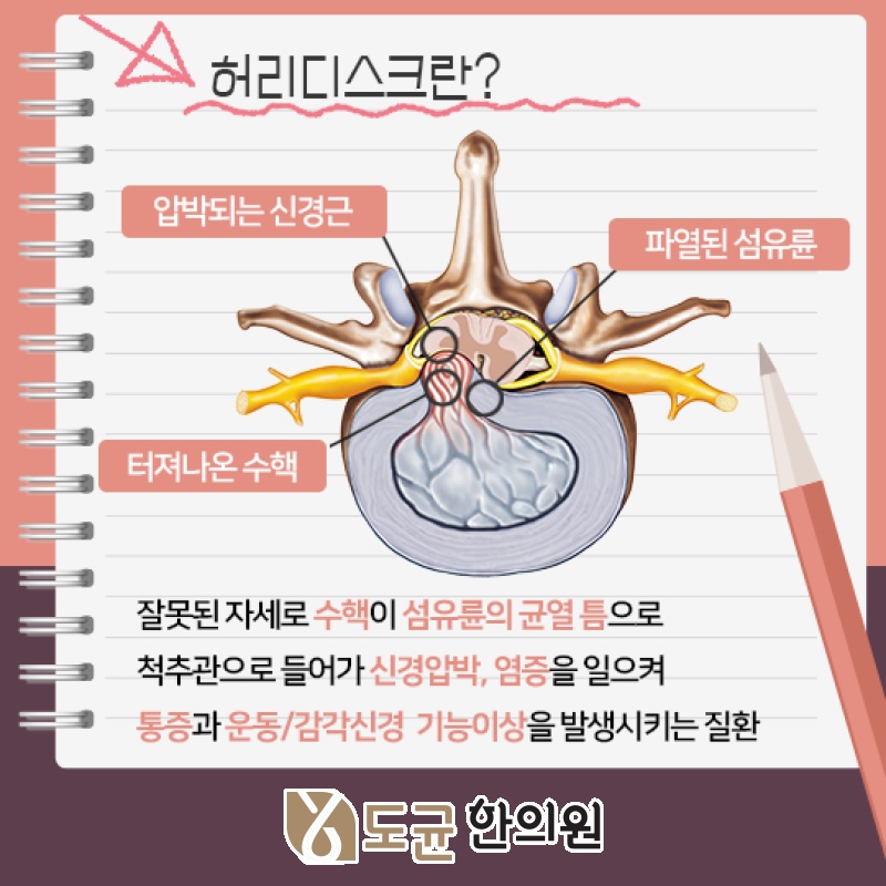 걸을 때 나타나는 허리디스크 하지 방사통의 특징