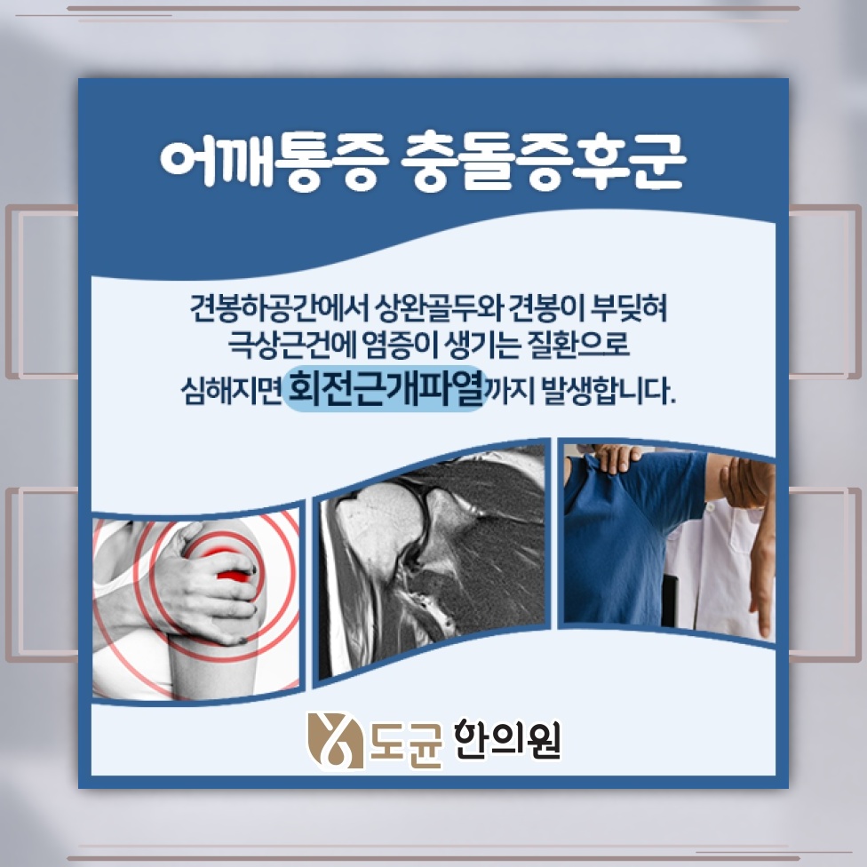 어깨 움직임을 방해하는 근육과 인대 손상, 충돌증후군