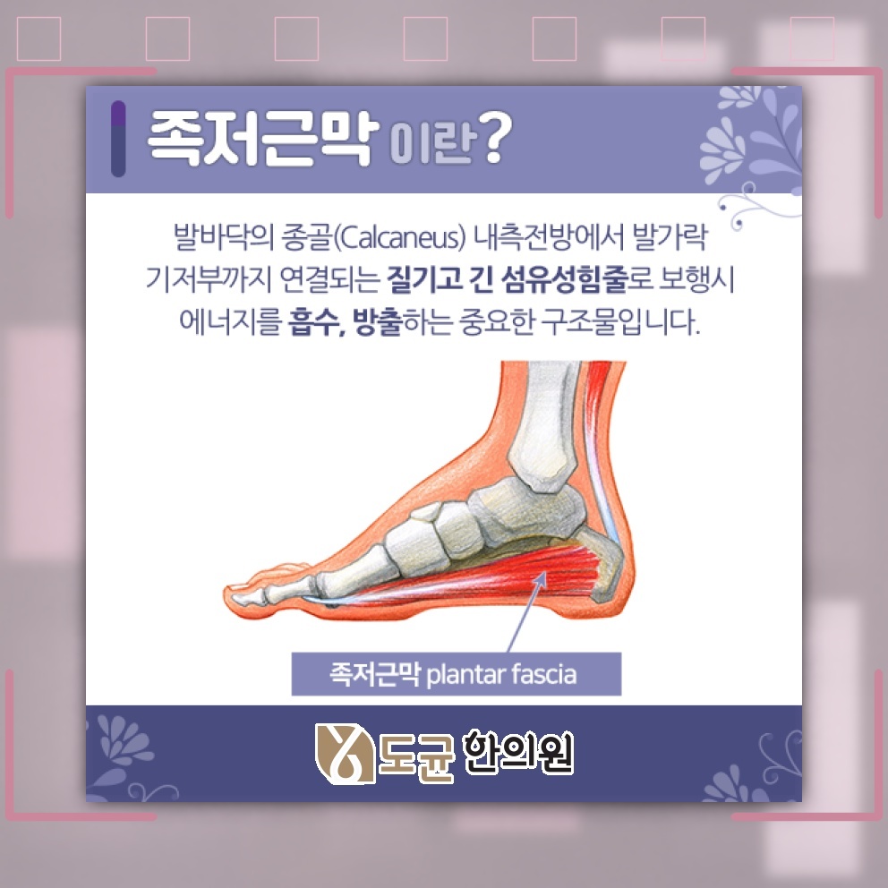 족저근막염으로 인한 발 통증, 회복을 돕는 관리법