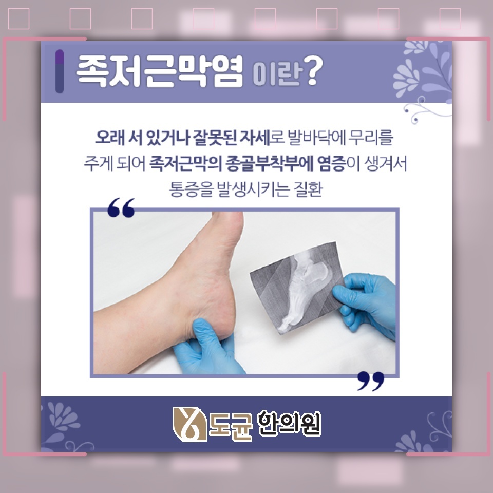 족저근막염으로 인한 발 통증, 회복을 돕는 관리법