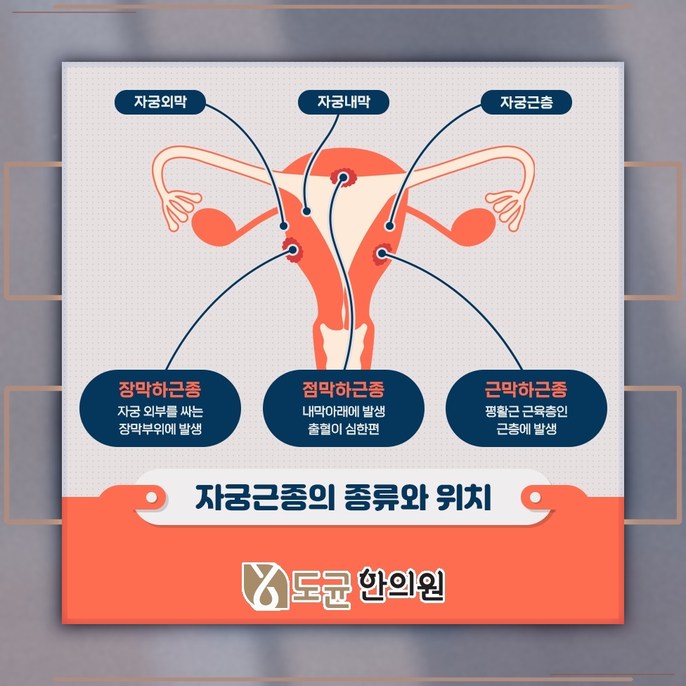 앉아 있는 시간이 길 때 자궁근종 위험과 생활 습관 점검