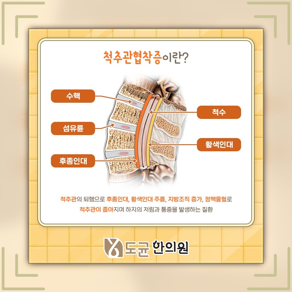 조금만 걸어도 쉬게 되는 척추관협착증의 보행 불편 살펴보기