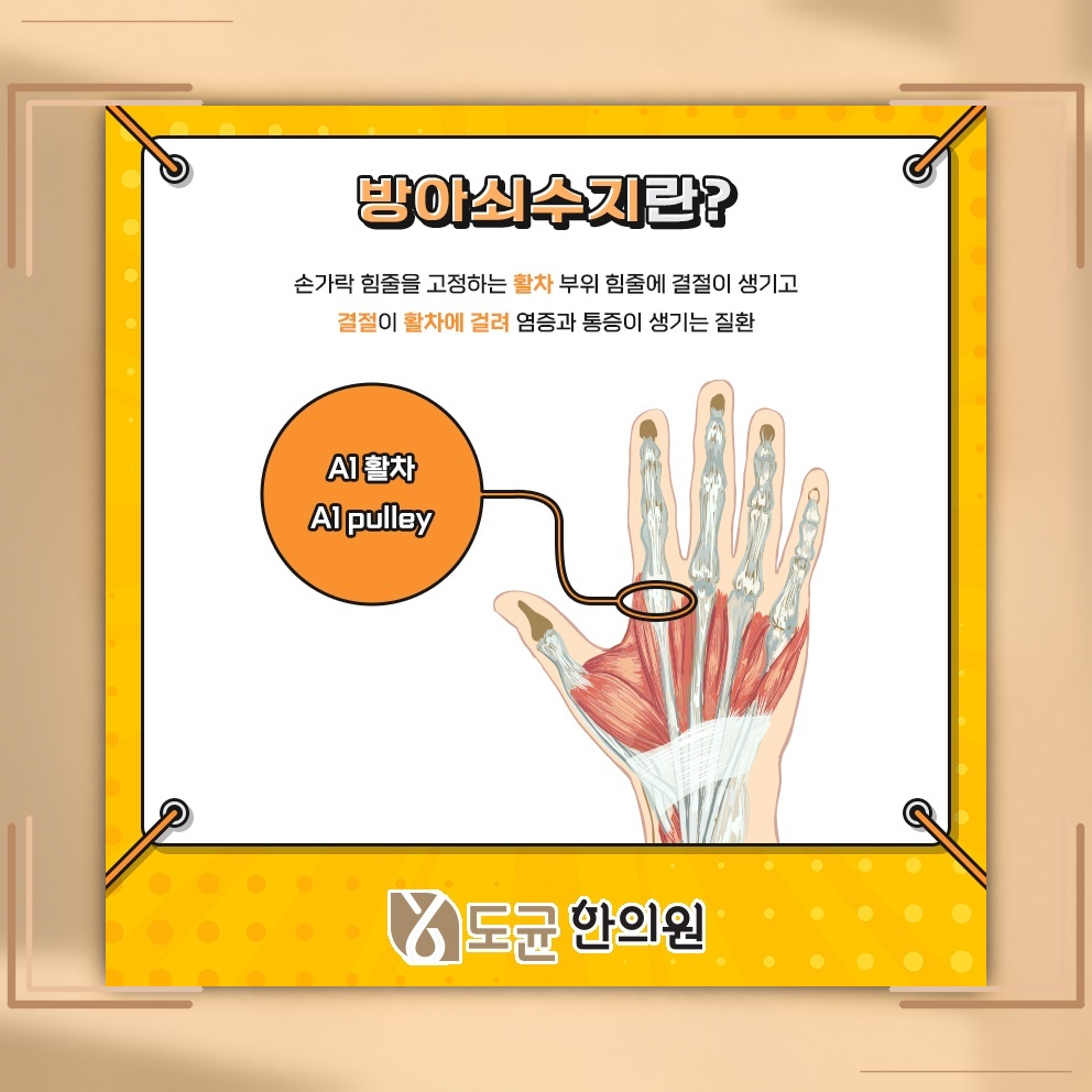 손가락이 붓고 아픈 방아쇠수지, 증상과 관리 방향