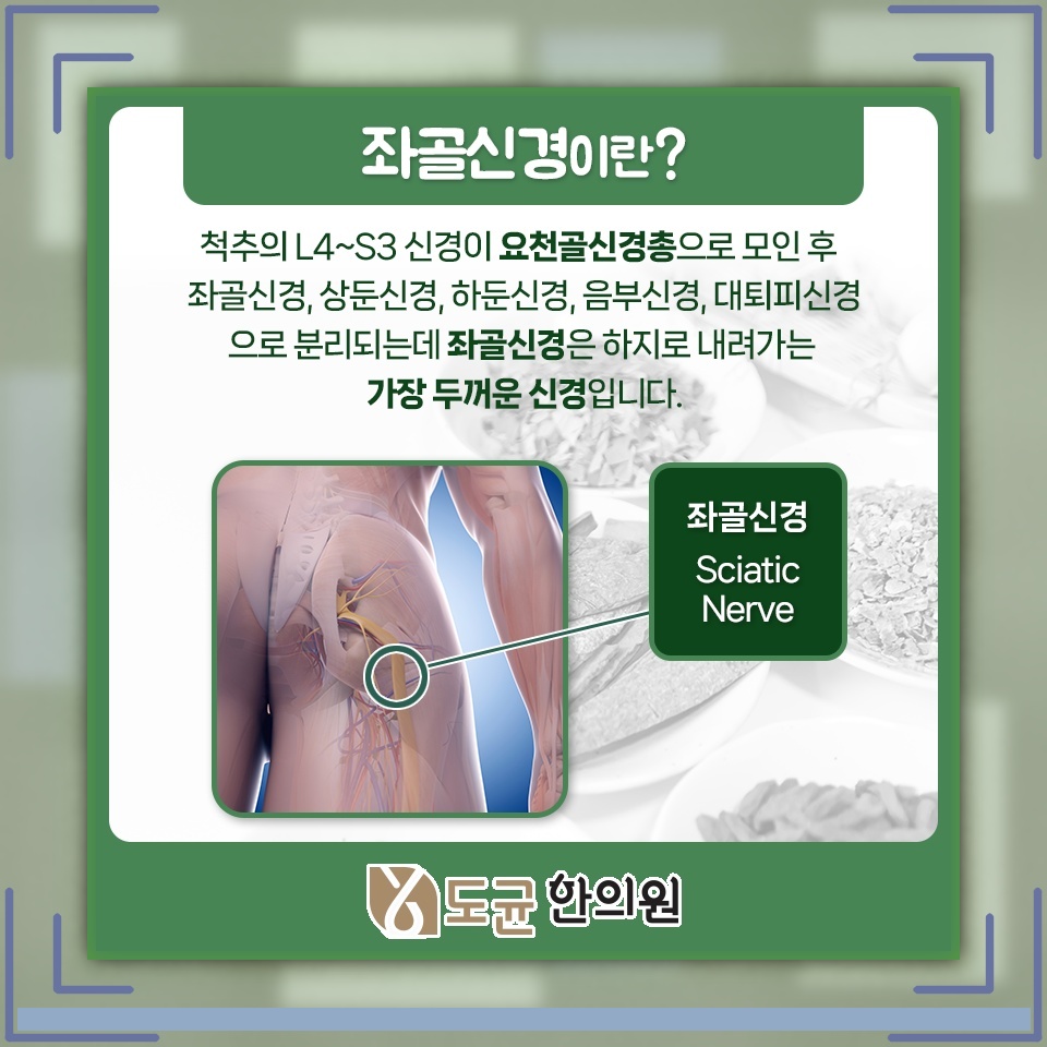 엉덩이 저림으로 오래 앉기 힘들다면 좌골신경통 점검