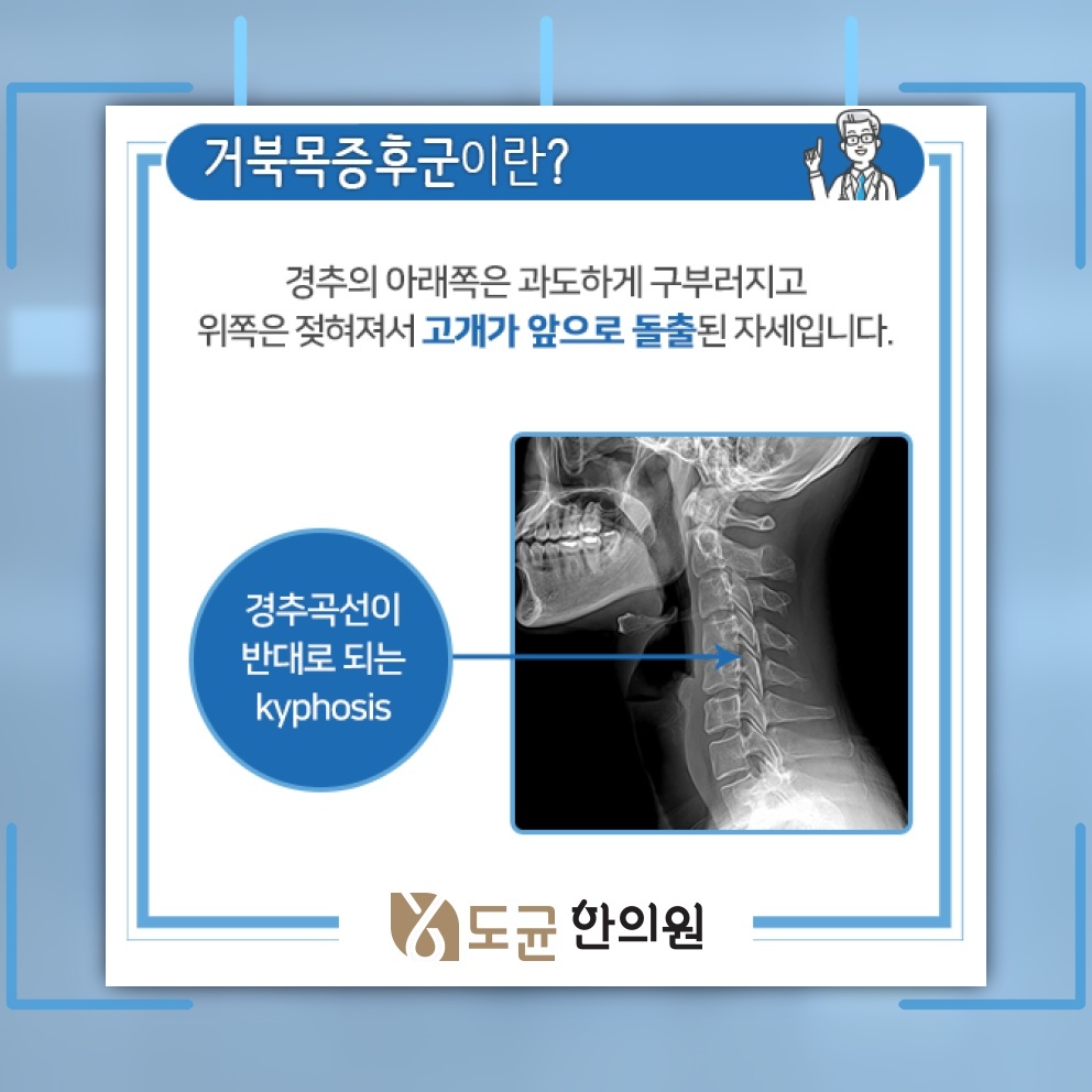 거북목증후군에서 나타나는 목 결림과 두통의 연관성