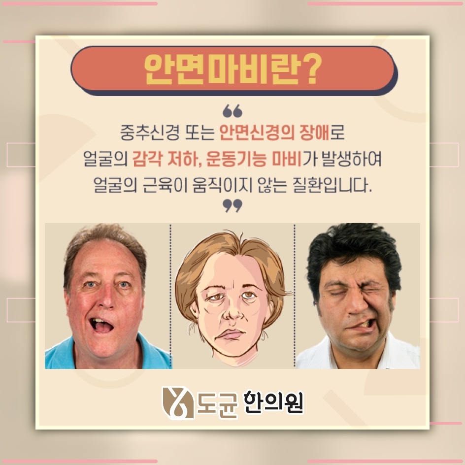 안면신경마비, 초기 대응 시점이 경과에 미치는 영향